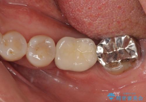 しみる奥歯 オールセラミッククラウンによる補綴治療の症例 治療前