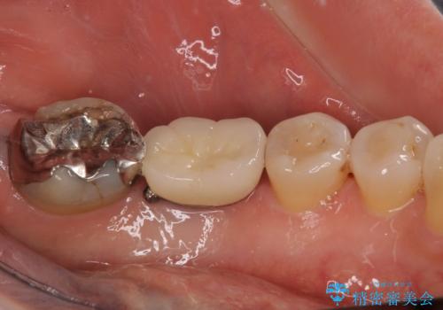 しみる奥歯 オールセラミッククラウンによる補綴治療の治療前