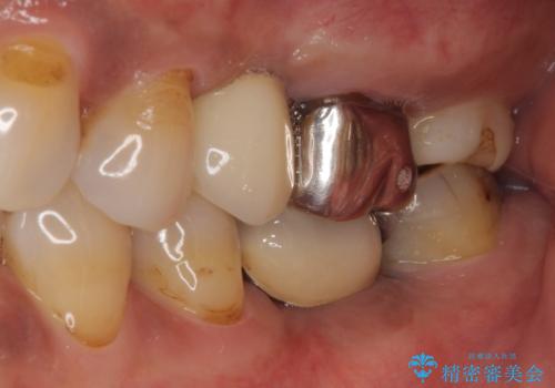 しみる奥歯 オールセラミッククラウンによる補綴治療の治療前