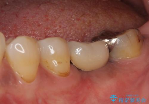 しみる奥歯 オールセラミッククラウンによる補綴治療の治療前