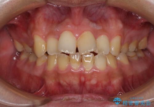 後戻りでデコボコの前歯 インビザライン矯正治療の治療前