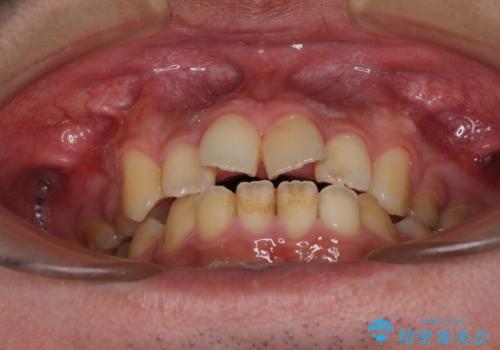 後戻りでデコボコの前歯 インビザライン矯正治療の治療前