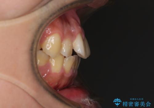 後戻りでデコボコの前歯 インビザライン矯正治療の治療前