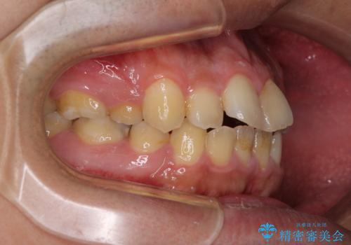 後戻りでデコボコの前歯 インビザライン矯正治療の治療前