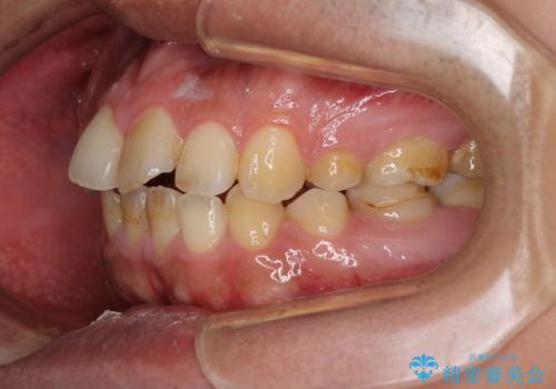 後戻りでデコボコの前歯 インビザライン矯正治療の治療前