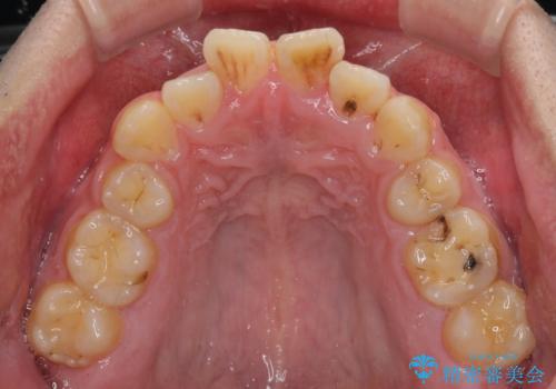 後戻りでデコボコの前歯 インビザライン矯正治療の治療前