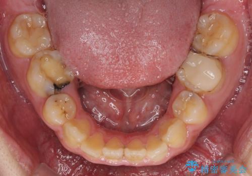 後戻りでデコボコの前歯 インビザライン矯正治療の治療前