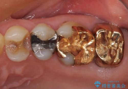 外れてしまった銀歯 セラミックインレーで自然な仕上がりにの治療前