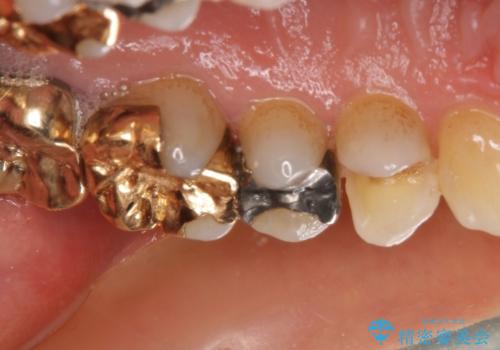 外れてしまった銀歯 セラミックインレーで自然な仕上がりにの治療前