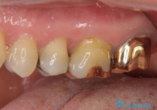 外れてしまった銀歯 セラミックインレーで自然な仕上がりにの治療前