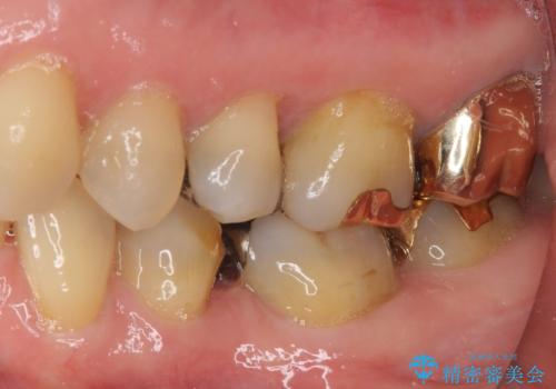 外れてしまった銀歯 セラミックインレーで自然な仕上がりにの治療前
