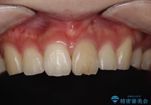 前歯が欠けるの症例 治療前
