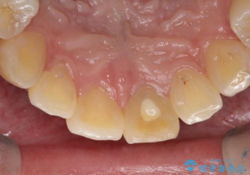 前歯が欠けるの治療前