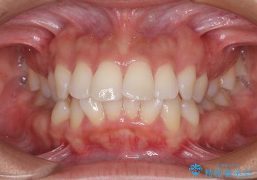 抜歯矯正で唇を閉じやすく　目立たないワイヤー装置の症例 治療前