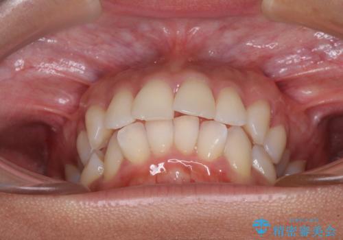 抜歯矯正で唇を閉じやすく 目立たないワイヤー装置の治療前