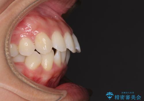 抜歯矯正で唇を閉じやすく 目立たないワイヤー装置の治療前