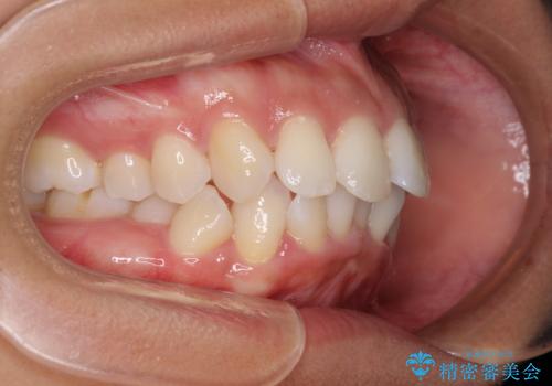 抜歯矯正で唇を閉じやすく 目立たないワイヤー装置の治療前