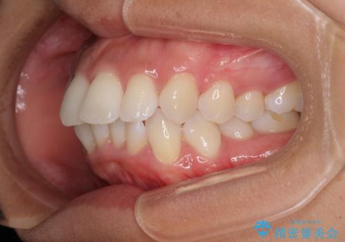 抜歯矯正で唇を閉じやすく 目立たないワイヤー装置の治療前