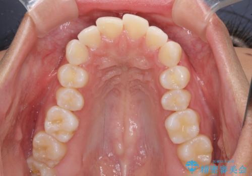 抜歯矯正で唇を閉じやすく 目立たないワイヤー装置の治療前
