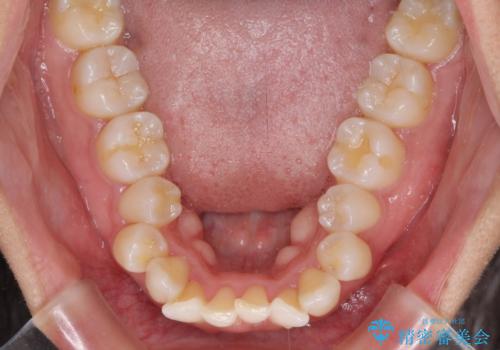 抜歯矯正で唇を閉じやすく 目立たないワイヤー装置の治療前