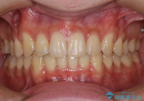 インビザライン:前歯のがたつきと噛み合わせの治療の症例 治療後