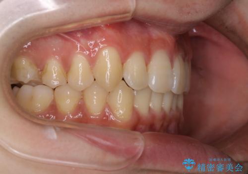 インビザライン:前歯のがたつきと噛み合わせの治療の治療後