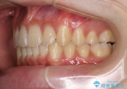 インビザライン:前歯のがたつきと噛み合わせの治療の治療後