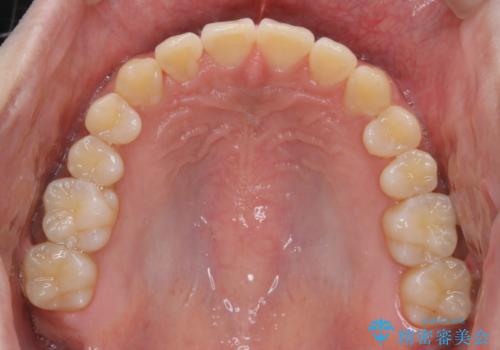 インビザライン:前歯のがたつきと噛み合わせの治療の治療後