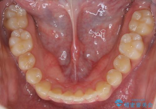 インビザライン:前歯のがたつきと噛み合わせの治療の治療後