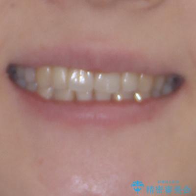 先天欠損のある歯列　インビザライン矯正の治療後（顔貌）