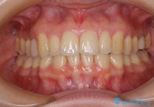 先天欠損のある歯列　インビザライン矯正の症例 治療後