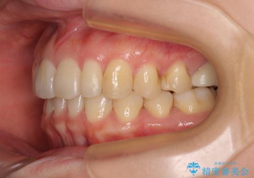 先天欠損のある歯列　インビザライン矯正の治療後