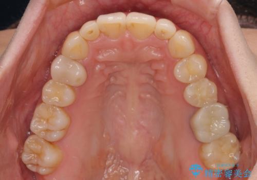 先天欠損のある歯列　インビザライン矯正の治療後