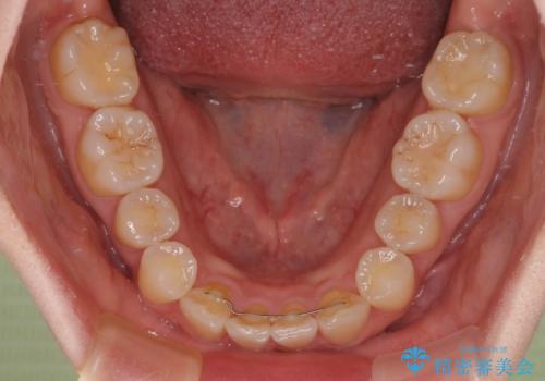 先天欠損のある歯列　インビザライン矯正の治療後
