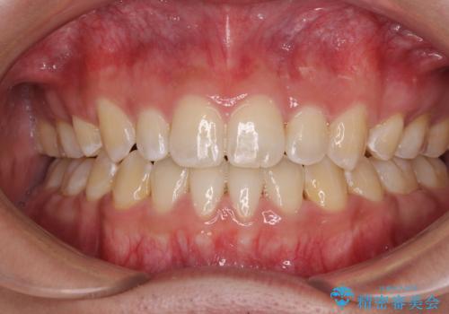 口元の突出感を改善　受け口傾向の咬み合わせの抜歯矯正の症例 治療後