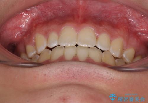 口元の突出感を改善　受け口傾向の咬み合わせの抜歯矯正の治療後