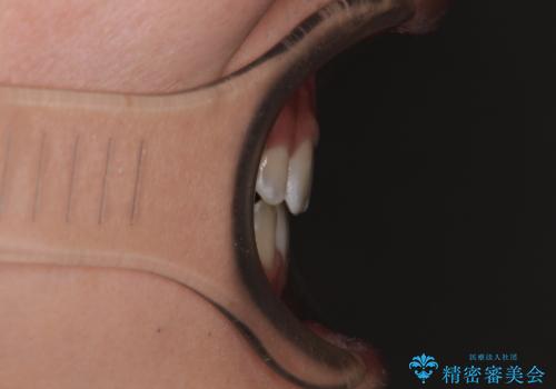 口元の突出感を改善 受け口傾向の咬み合わせの抜歯矯正の治療後