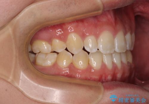 口元の突出感を改善　受け口傾向の咬み合わせの抜歯矯正の治療後