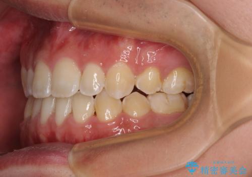口元の突出感を改善 受け口傾向の咬み合わせの抜歯矯正の治療後