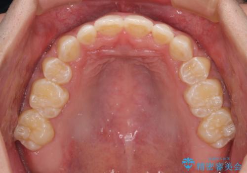 口元の突出感を改善 受け口傾向の咬み合わせの抜歯矯正の治療後
