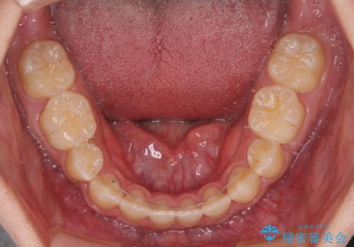 口元の突出感を改善 受け口傾向の咬み合わせの抜歯矯正の治療後