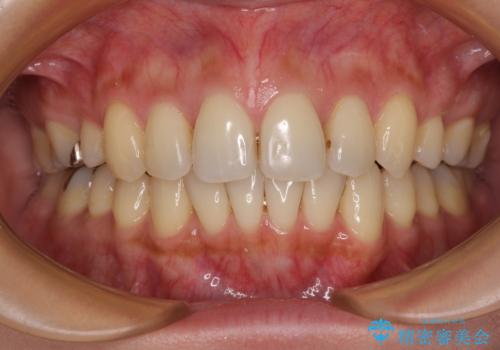 上顎前歯の突出を軽減　インビザラインによる抜歯矯正