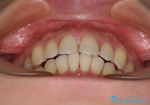 上顎前歯の突出を軽減 インビザラインによる抜歯矯正の治療後