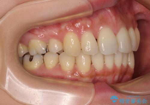 上顎前歯の突出を軽減　インビザラインによる抜歯矯正の治療後