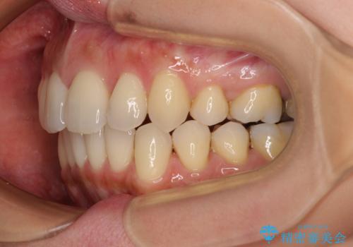 上顎前歯の突出を軽減 インビザラインによる抜歯矯正の治療後