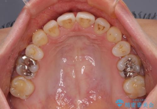 上顎前歯の突出を軽減　インビザラインによる抜歯矯正の治療後