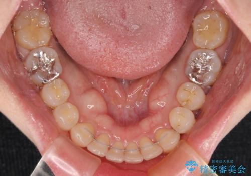 上顎前歯の突出を軽減 インビザラインによる抜歯矯正の治療後