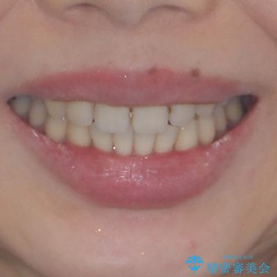 上顎前歯の突出を軽減 インビザラインによる抜歯矯正の治療後(顔貌)