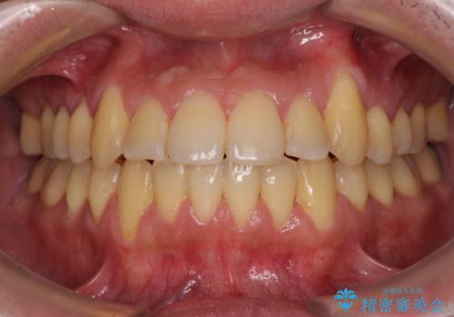 八重歯とクロスバイト　目立たないワイヤー装置で矯正治療の症例 治療後