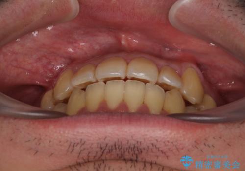 八重歯とクロスバイト 目立たないワイヤー装置で矯正治療の治療後